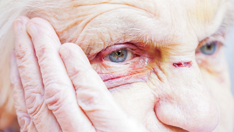 Une senior a des écorchures au visage